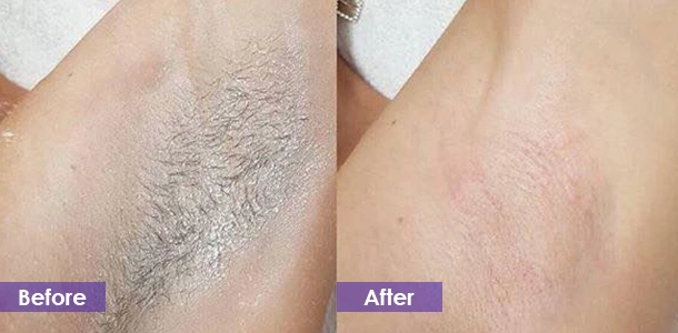 Underarm hair removal before and after