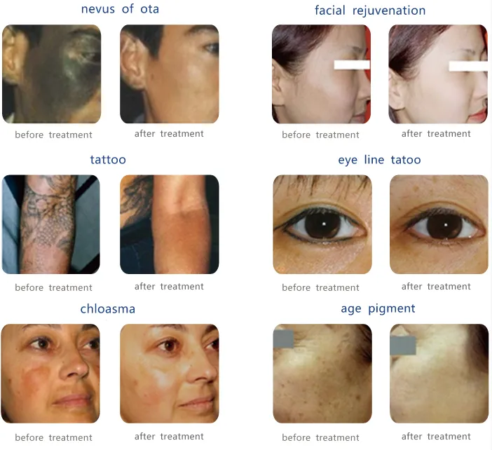 tattoo removal treatment before and after