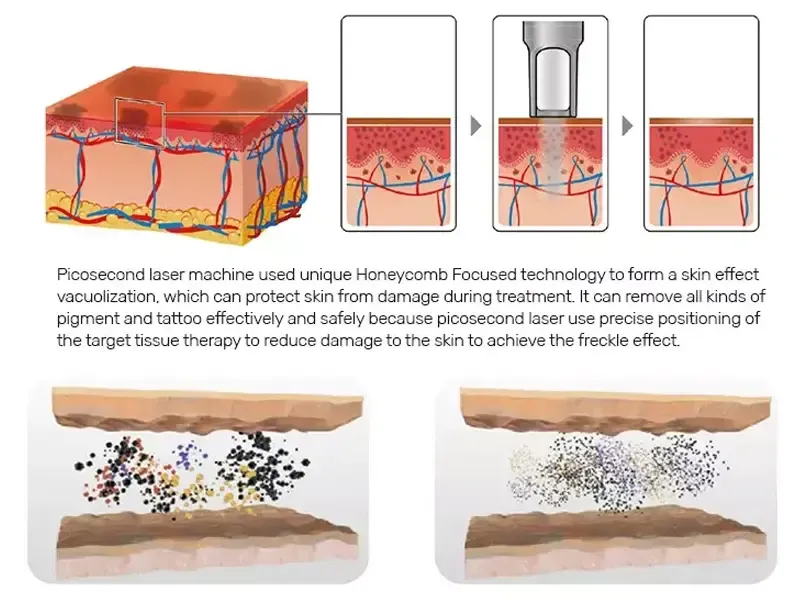 How a Picosecond Laser Machine Works
