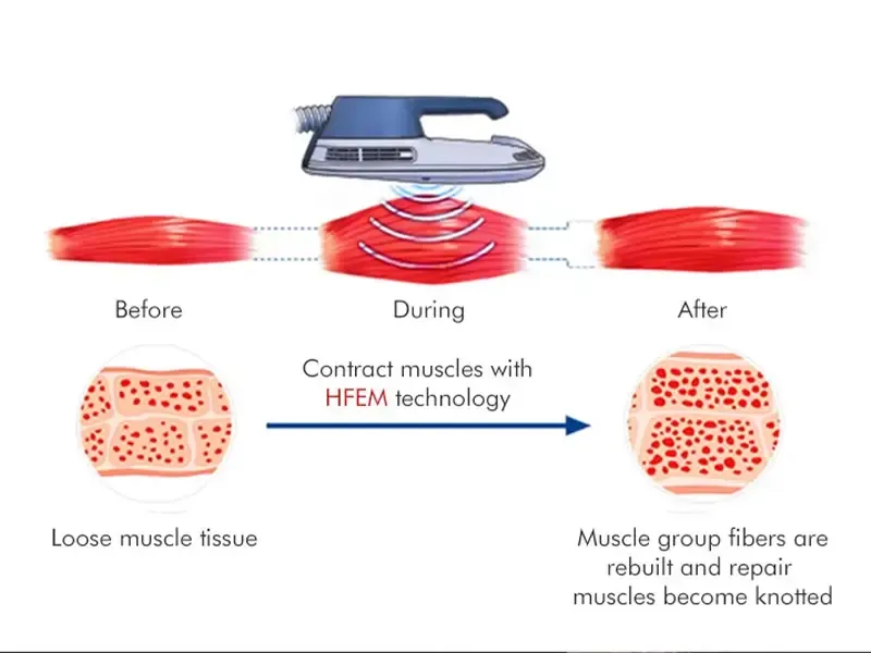 How the EMS body sculpting Machine Works