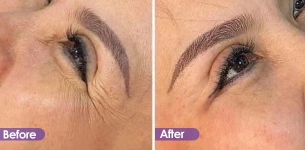 Wrinkle removal and firming around the eyes before and after