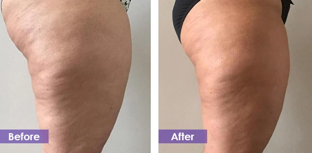 Leg fat loss before and after