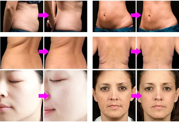 Portable RF body contouring Before & After