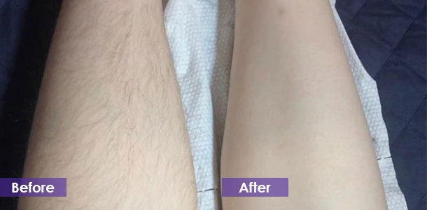 Leg hair removal before and after