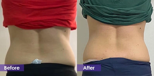 EMS-скульптурирование Waist Tightening before and after