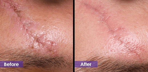 RF Microneedling to reduce scars treatment result