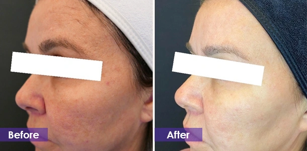 Microneedle RF Skin Rejuvenation before and after