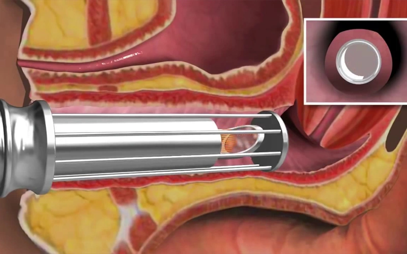 CO2 laser Vaginal Mode