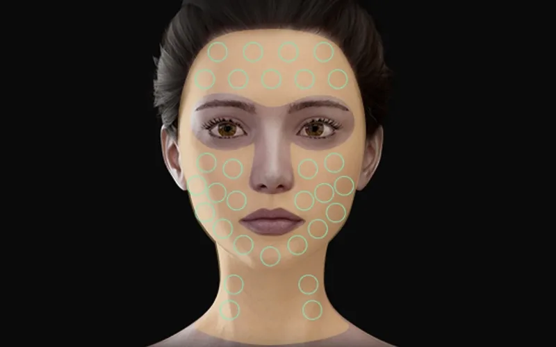 360 MAX HIFU Micro-pulse treatment