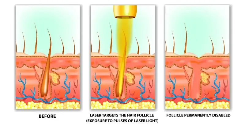diode laser machine Working Principle