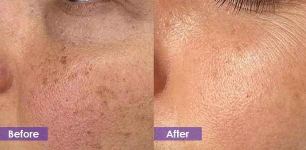 Facial spot removal before and after