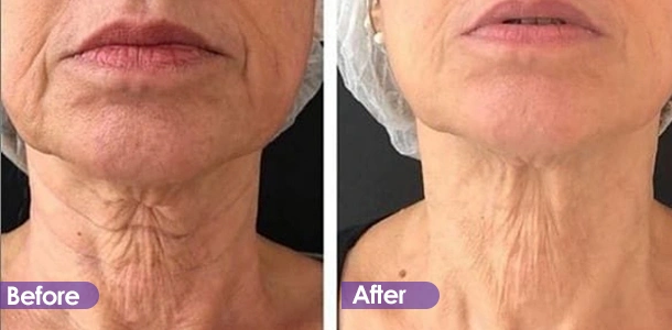 Neck wrinkle removal and firming before and after