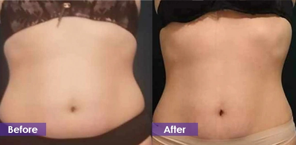 EMS Waist Sculpting before and after