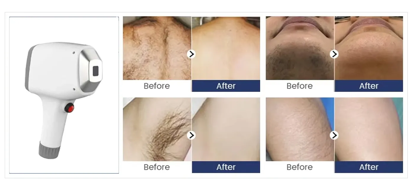 diode laser hair removal before and after